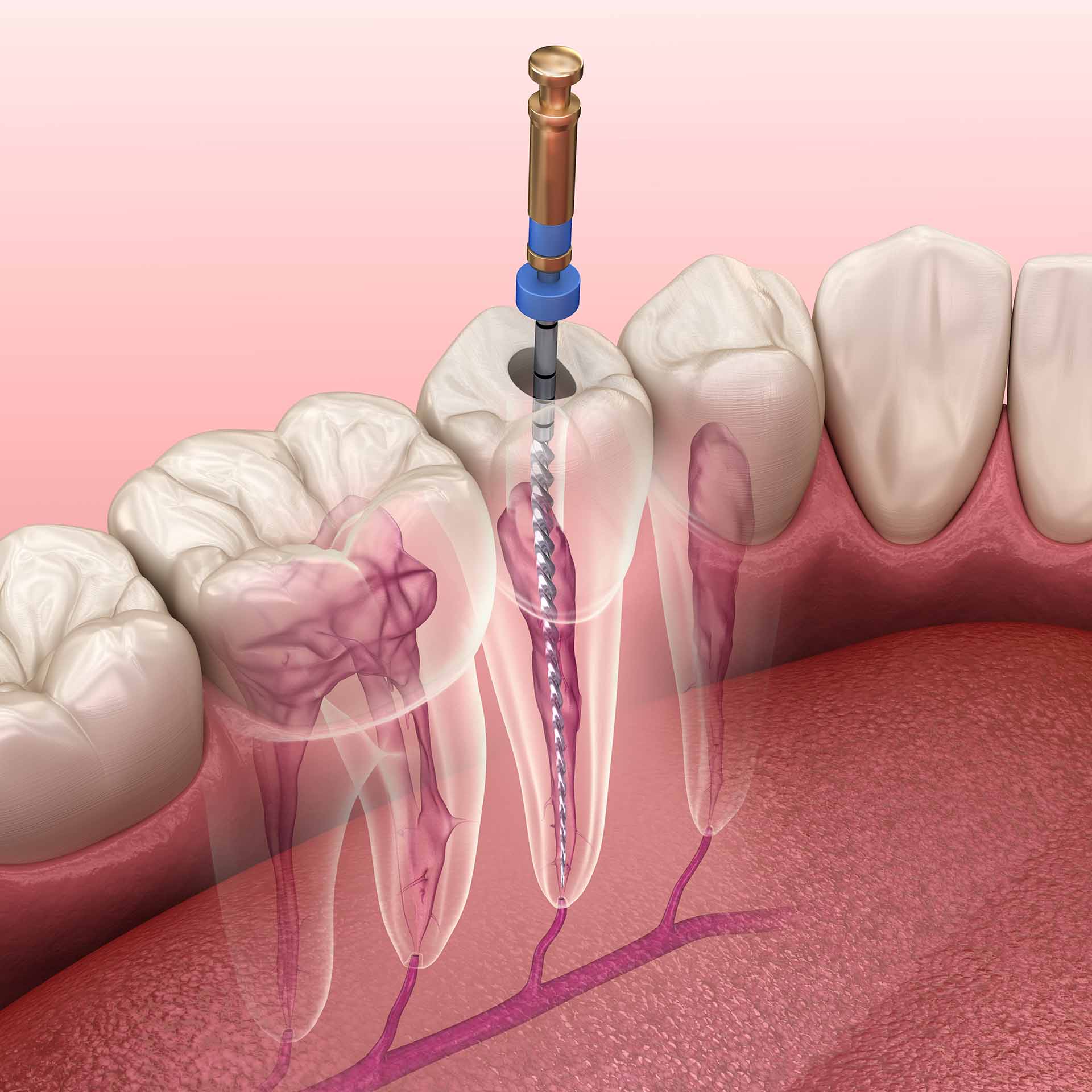 Root canals Endodontic root canal treatment process. Medically accurate tooth 3D illustration. Ivy Lane Dentistry offers root canal treatment for patients in San Antonio, TX