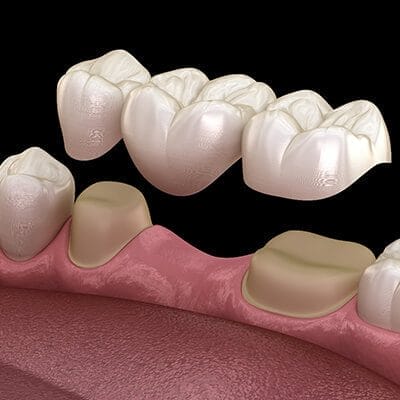 Dental Bridges Infographic of human in dental bridge on white background illustration. Ivy Lane Dentistry offers Dental Bridges in San Antonio, TX. <a href="https://www.freepik.com/free-vector/infographic-human-dental-bridge-white-background_24779460.htm#query=dental%20bridge&position=0&from_view=keyword&track=ais">Image by brgfx</a> on Freepik